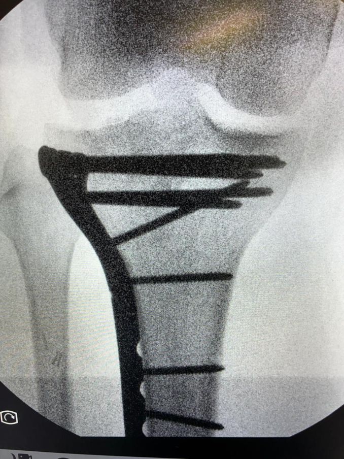 Emilio Serna, operado con éxito de la fractura de tibia tras la grave cogida de Acho