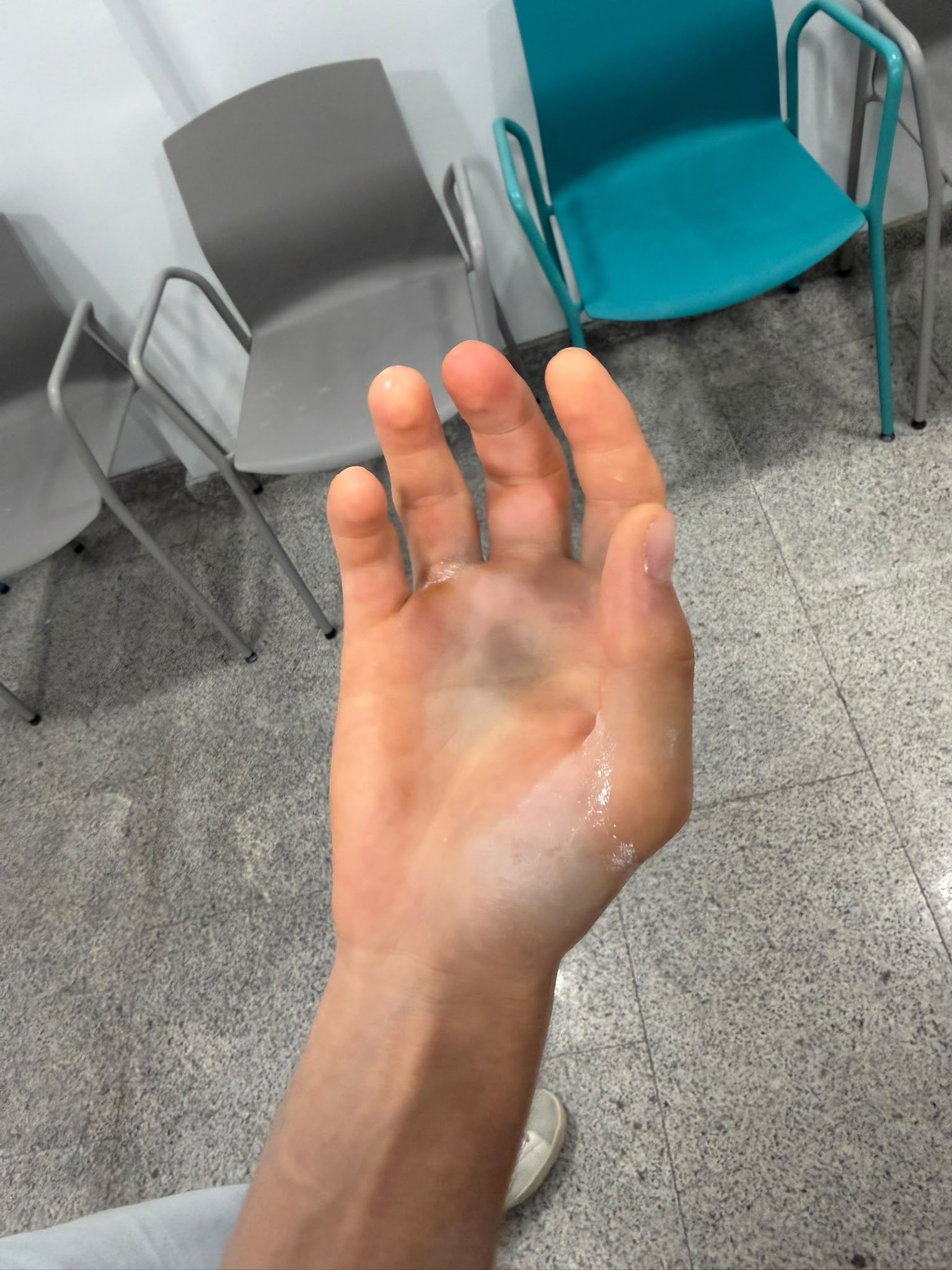 Álvaro Serrano sufre una fractura en un dedo de la mano derecha tras su actuación en Valencia